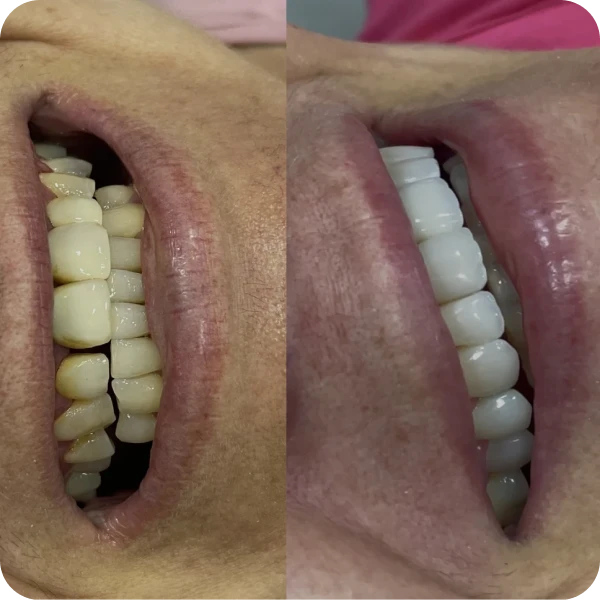 Lentes de Resina Estratificada - Mogi das Cruzes
