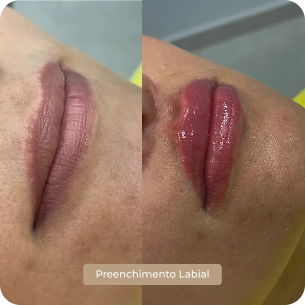 Preenchimento Labial em Mogi das Cruzes