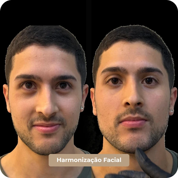 Harmonização Facial em Mogi das Cruzes