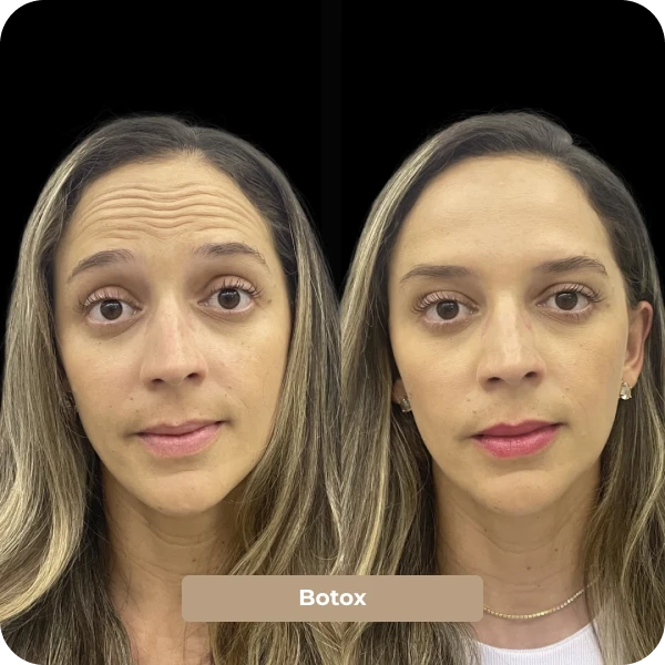 Botox em Mogi das Cruzes
