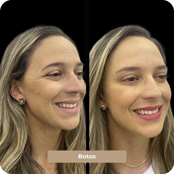 Botox em Mogi das Cruzes